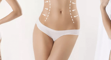 Liposuction